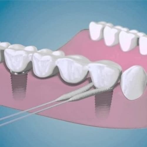 TePe Bridge & Implant Floss zubní nit, 5ks (sáček) - náhled 2