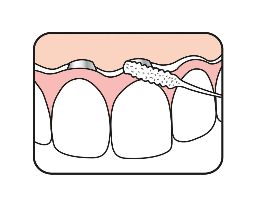 TePe Bridge & Implant Floss zubní nit, 30ks - náhled 4