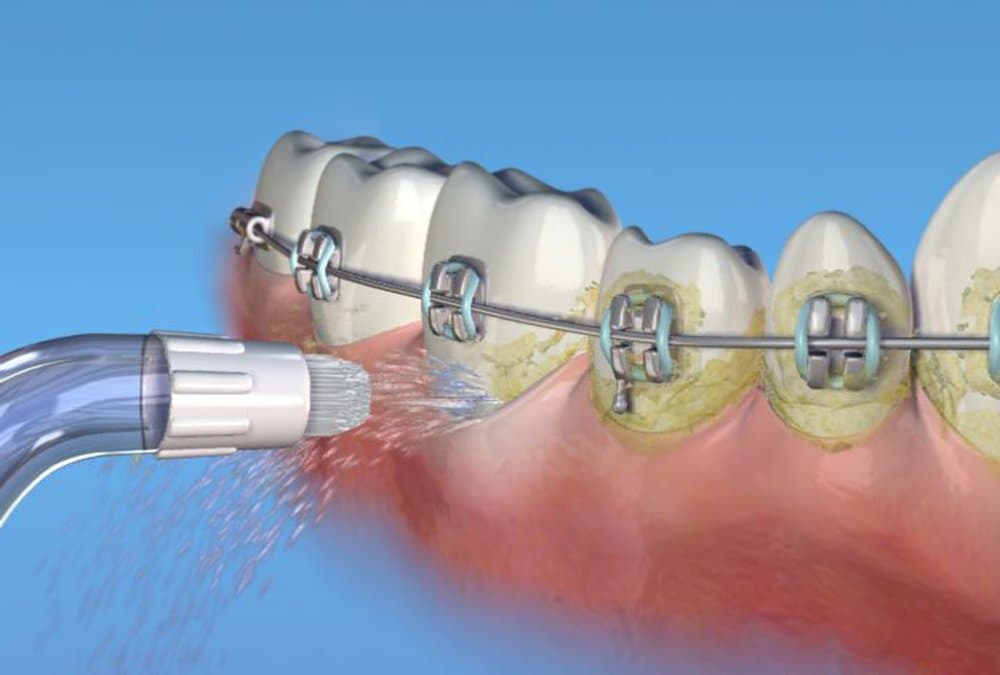 Waterpik Orthodontic trysky OD100, 2ks - náhled 3